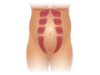 Abdominal separation, also known as diastasis recti, is a common condition  that can occur during pregnancy and childbirth. It is…